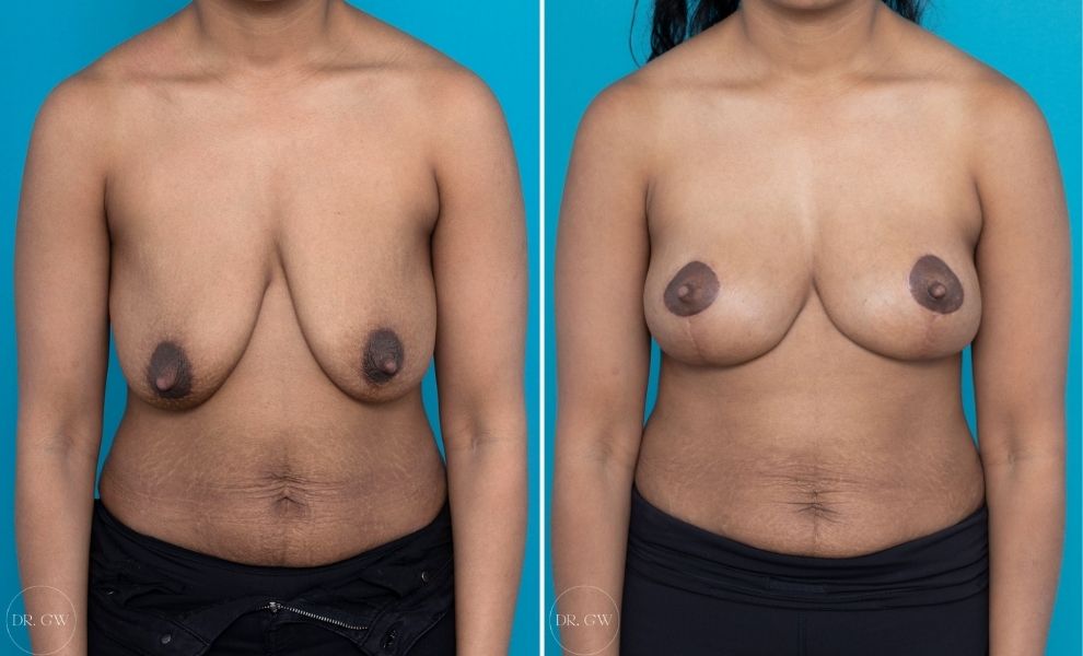 alnaher salikala recommends huge saggy tits pic